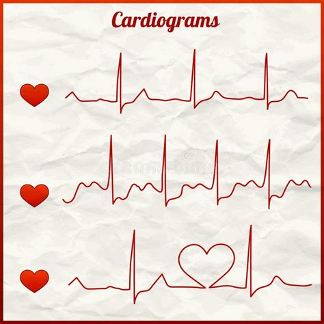 Een Reeks Cardiogrammen Van Het Hart Het Concept Een Gezond Hart