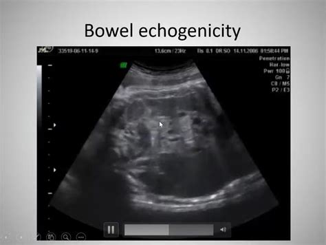 echogenic bowel  obstetric ultrasound