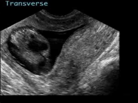 Megacystis Ultrasoundpaedia