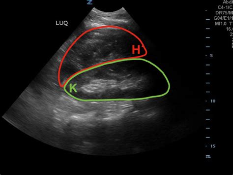 Renal Subcapsular Hematoma Ultrasound 2 Annotated JETem 2019 JETem