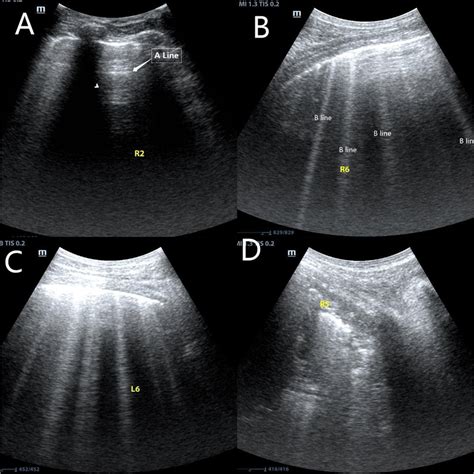 Lung Ultrasound Scores Determined By The Number Of B Lines And