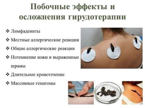 Медицинская пиявка (Hirudo medicinalis) - online presentation