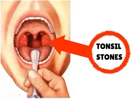 How To Get Rid Of Tonsil Stones Fast Best Tonsil Stones Treatment