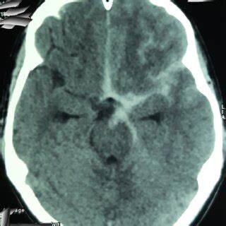 Non Contrast Ct Brain Axial Cuts Showing Subarachnoid Hemorrhage