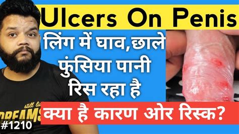 Penis Ulcer And Pimples Causes In Hindi Genital Ulcer In Hindi Youtube