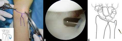 Arthroscopic One Tunnel Transosseous Foveal Repair For Triangular