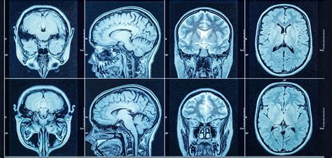 Non-Traumatic Brain Injury | Kootenay Brain Injur