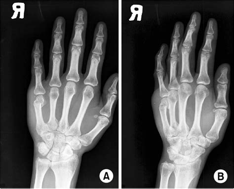 A Preoperative Anteroposterior And B Oblique Radiographs Of The