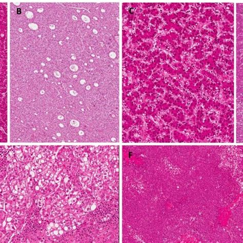 Histological Patterns Of Hcc A Trabecular Pattern Of Hcc Download Scientific Diagram