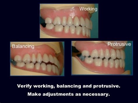 7 Try In Of The Wax Trial Complete Denture