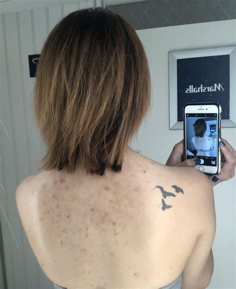 HELP! My back acne scars have destroyed my confidence and makes me want ...