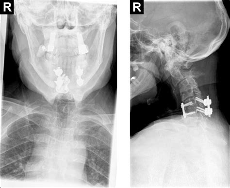 Case 3 Cervical Spine Anteroposterior And Lateral Radiographs