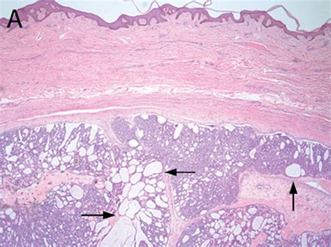 A A Nodular Well Circumscribed Basophilic Tumor Involved The Dermis