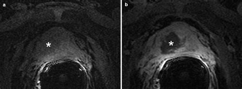 Prostate Cancer Imaging Radiology Key