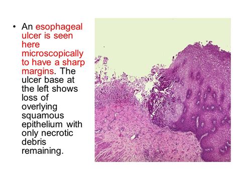 Esophageal Ulcer Histology