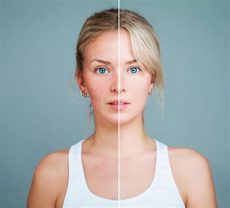Prp Treatment For Acne Prpmedde
