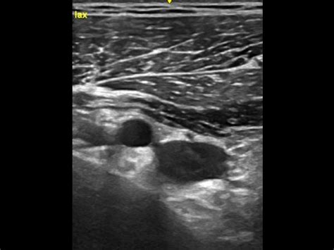 Thoracic Outlet Syndrome Ultrasound Cases