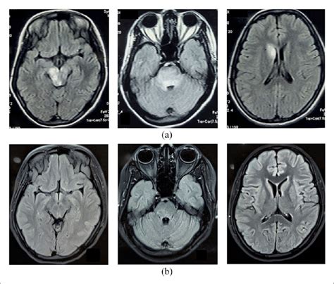 Magnetic Resonance Imaging Brain Showing Hyperintensity In Brainstem