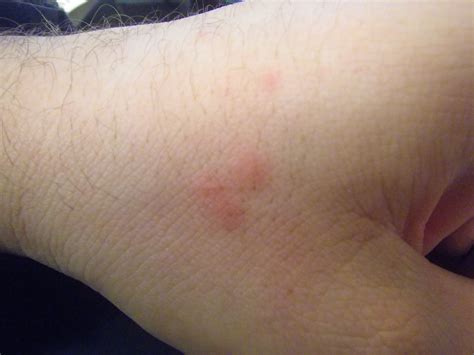 Bed Bug Bites | Bed Bugs