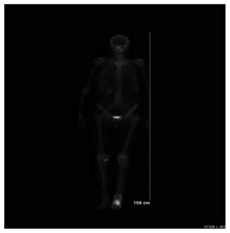 Technetium M Mdp Whole Body Bone Scan Displaying Intense Increased