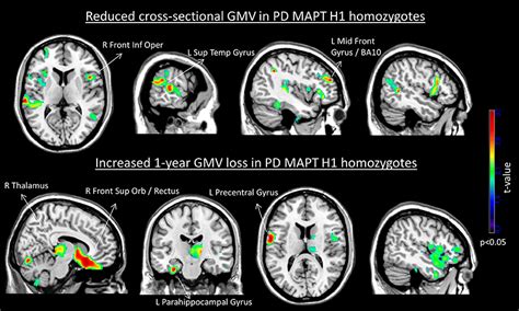 Frontiers Early Gray Matter Volume Loss In Mapt H1h1 De Novo Pd