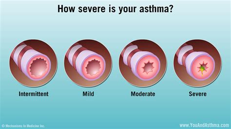 Diagnosing Asthma: Mild, Moderate, and Severe