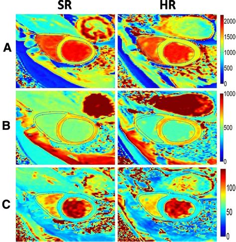 Myocardial T1 And T2 Mapping At The Mid Ventricular Level Of A SR And