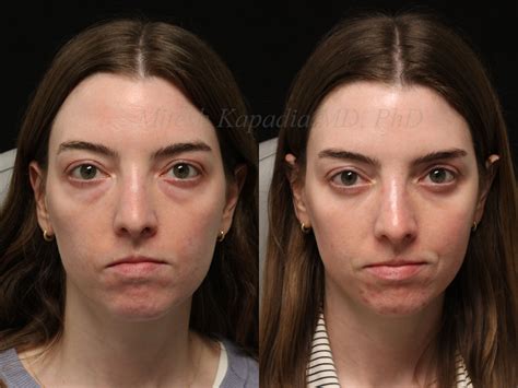 Before and six months after lower blepharoplasty surgery | Boston