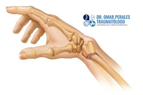 Fractura De Radio Distal Dr Perales Traumatólogo