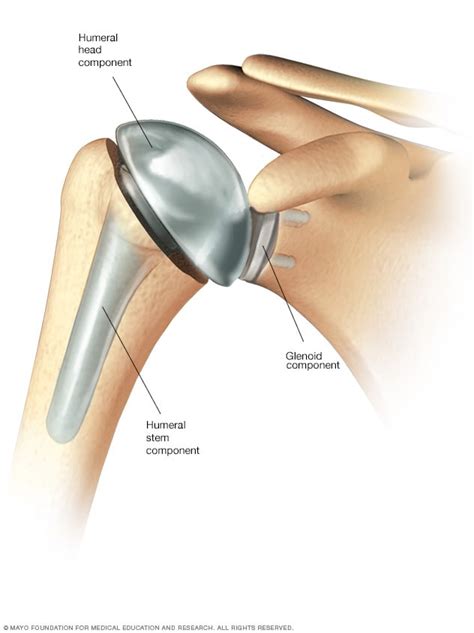 Shoulder Replacement Surgery Mayo Clinic