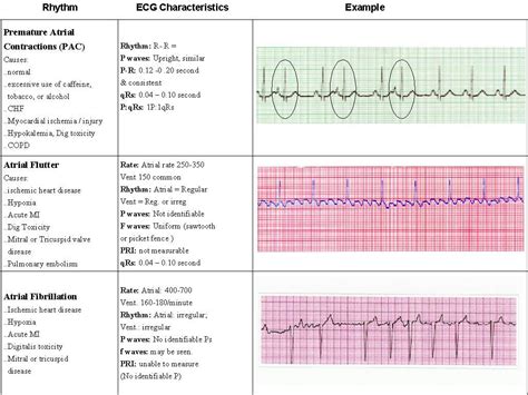 Best Way To Learn Ekg Rhythms - Just For Guide