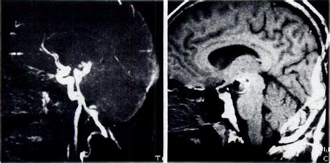 A Giant Aneurysm At Top Of Basilar Artery Seen On Sagittal D