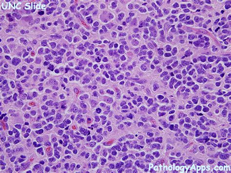 anaplastic oligodendroglioma pathology