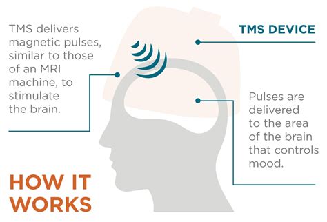 Tms Vs Ect Tms West Tms Treatment Therapy Perth