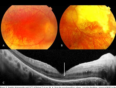 Pdf Ocular And Extra Ocular Features Of Patients With Leber