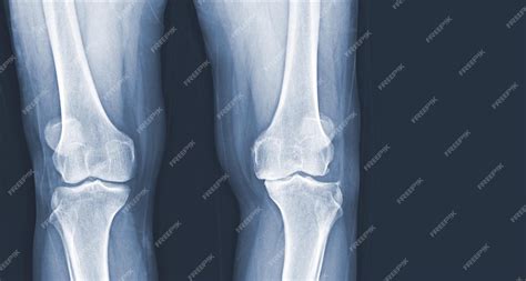 Radiographie Du Film De Larthrose Du Genou Humain Des Ligaments