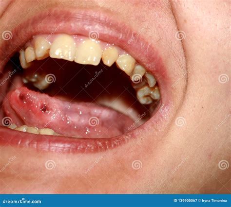 Amphotoid Stomatitis Candidiasis Of The Tongue Ulcer On The Tongue Candida Fungus Stock