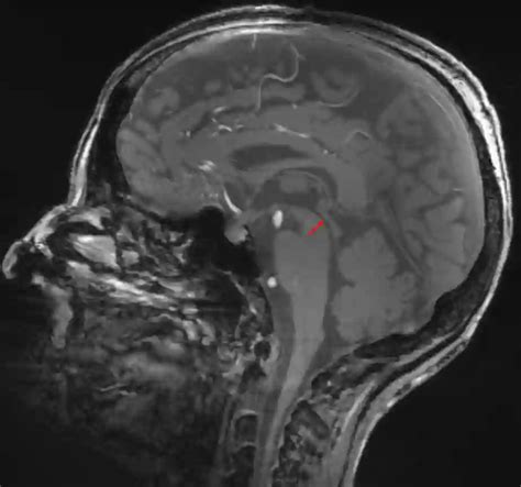 Aquaeductus Mesencephali Ars Neurochirurgica