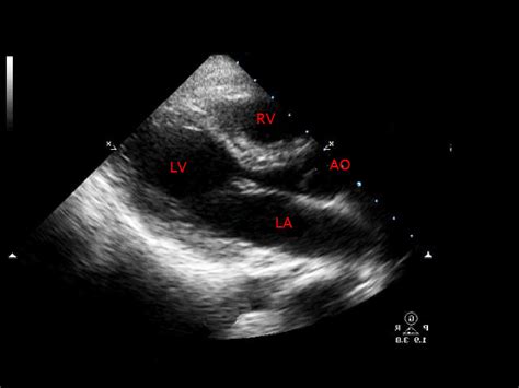 Ultrasound Guided Pericardiocentesis Core Em