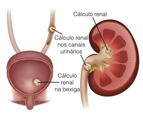 Cálculo Renal Tratamento Causas Diagnóstico Sinais e sintomas