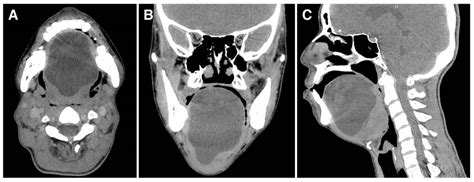 Floor Of Mouth Dermoid Cyst Radiology