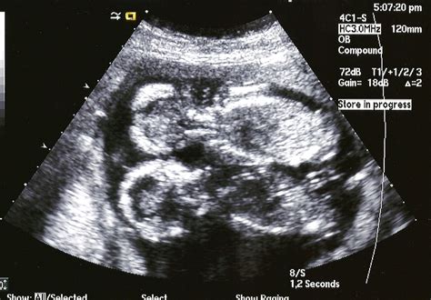 Smithback Twins 16 Week Ultrasound Pictures