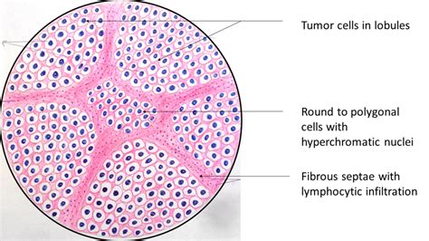 Dysgerminoma: Ovary - Pathology Made Simple