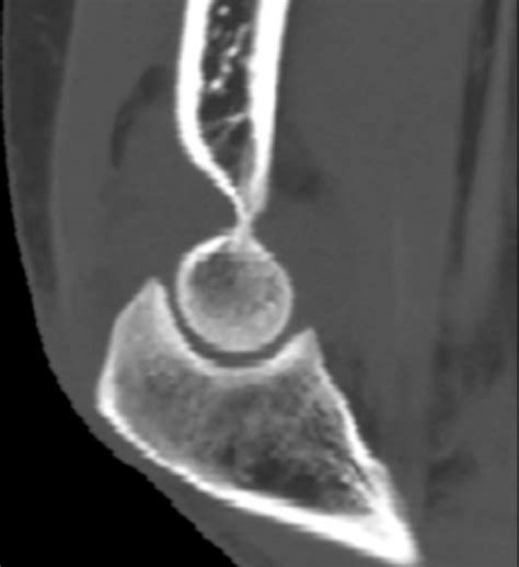 Radial head fracture - wikidoc