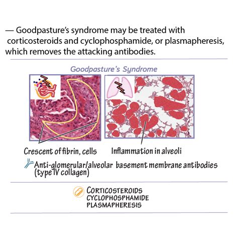 Pathology Glossary: Goodpasture’s syndrome | Draw It to Know It