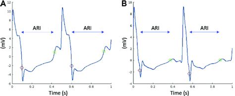 Example Of Unipolar Endocardial Electrograms With Calculated Activation