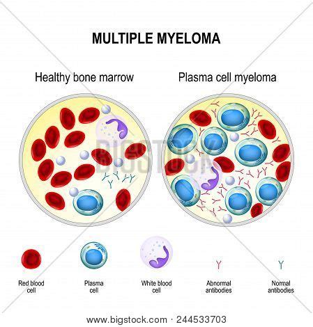 Multiple Myeloma Vector & Photo (Free Trial) | Bigstock