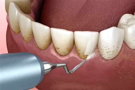 Teeth Scaling Vs Cleaning Understanding The Benefits Of Each