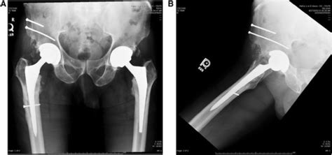 Post Operative Anteroposterior AP And Lateral Hip Radiographs A B