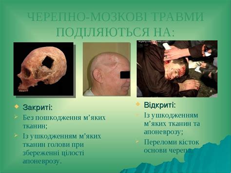 Презентація "Травми головного мозку" | Презентація. Медицина